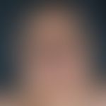 Lipomatosis, benign symmetrical type I) . 64-year-old patient. typical Madelung`scher fat neck. i...