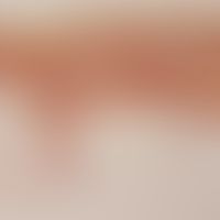 Livedo racemosa. Histology, overview magnification. Vascular occlusion in deep corium. Elastica v...