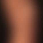Livedo racemosa:generalized livedo racemosa with characteristic bizarre reddening of the skin, wh...