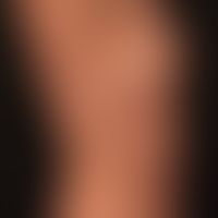 Livedo racemosa:generalized livedo racemosa with characteristic bizarre reddening of the skin, wh...