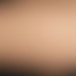 Livedo reticularis. Großmaschige, livide Marmorierung am linken Unterarm einer 30-jährigen Patien...