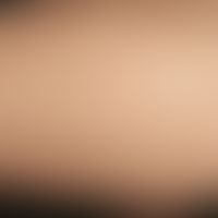 Livedo reticularis. Großmaschige, livide Marmorierung am linken Unterarm einer 30-jährigen Patien...