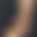 Livedovaskulopathie:&nbsp;hämorrhagisch-nekrotische Lasionen auf erythematösem Grund. Periulzerös...