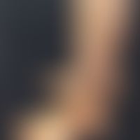 Livedovaskulopathie:&nbsp;hämorrhagisch-nekrotische Lasionen auf erythematösem Grund. Periulzerös...