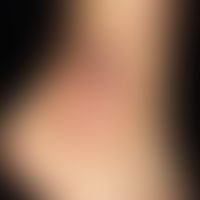 Livedovaskulopathie:&nbsp;bizarre, stark schmerzhafte Ulzera und hämorrhagische Plaques im Bereic...