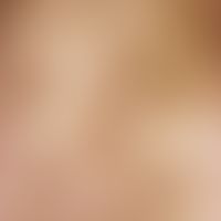Melanodermia factitia. Auftreten von streifenförmig verlaufenden Flecken und Plaques mit nachfolg...