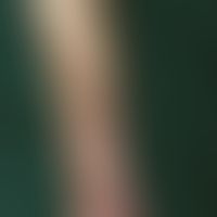 Melanodermia factitia. Streifige, an den Venenverlauf gebundene, bräunliche Pigmentierung nach Ch...