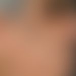 Melanodermatitis toxica. solitary, chronically stationary (no growth dynamics), large-area, blurr...