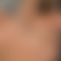 Melanodermatitis toxica. solitary, chronically stationary (no growth dynamics), large-area, blurr...