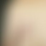 Melanom mdetastasiertes: foudroyant einsetzende, diffuse, kutane Metastasierung um die ältere Ope...