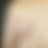Melanom mdetastasiertes: foudroyant einsetzende, diffuse, kutane Metastasierung um die ältere Ope...