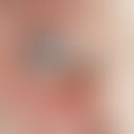 Melanom, malignes. Schwarz pigmentierter Knoten im Bereich der Bindehaut des lateralen Augenwinke...