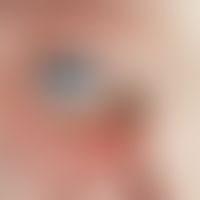 Melanom, malignes. Schwarz pigmentierter Knoten im Bereich der Bindehaut des lateralen Augenwinke...