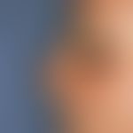 Melanom, malignes, Lentigo-maligna-Melanom. Bizarr konfigurierter, braun-schwarzer Fleck auf UV g...