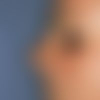 Melanom, malignes, Lentigo-maligna-Melanom. Bizarr konfigurierter, braun-schwarzer Fleck auf UV g...
