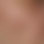 Lentigo-maligna-Melanom. Übersichtsaufnahme: 1,2 x 0,5 cm großes (unscheinbares), braunes&nbsp;Le...