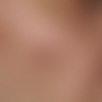 Lentigo-maligna-Melanom. Übersichtsaufnahme: 1,2 x 0,5 cm großes (unscheinbares), braunes&nbsp;Le...