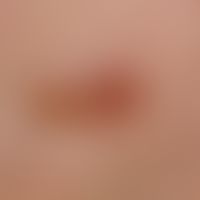 Lentigo-maligna-Melanom. Detailvergrößerung: 1,2 x 0,5 cm großer, unregelmäßig pigmentierter, uns...
