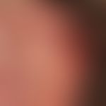 Lentigo-maligna-Melanom: seit mehreren Jahren bekannter, langsam wachsender, zunächst homogen bra...