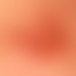 Ameanotisches Lentigo-maligna-Melanom: weitgehend amelanotische Plaque (Erklärung s. Detailaufnah...