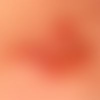 Ameanotisches Lentigo-maligna-Melanom: weitgehend amelanotische Plaque (Erklärung s. Detailaufnah...