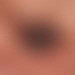 Lentigo maligna Melanom: Seit Jahren bekannter, zunächst braune, dann allmählich schwarze,&nbsp;a...