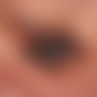 Lentigo maligna Melanom: Seit Jahren bekannter, zunächst braune, dann allmählich schwarze,&nbsp;a...