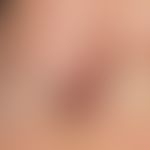 Melanom, malignes, akrolentiginöses. Zentral amelanotischer Tumor mit dunkelbraunem, unregelmäßig...