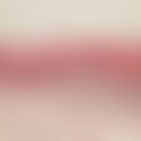Melanoma, malignant, acrolentiginous, intraepidermal and subepidermal infiltration of melanoma ce...