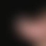 Melanom, malignes, akrolentiginöses. Detailvergrößerung des rechten Daumens: Flächenhaft wachsend...