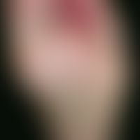 Melanoma, malignant, acrolentiginous. Here: amelanotic malignant melanoma: Chronic inpatient tumo...