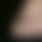 Melanom, malignes, akrolentiginöses. Solitärer, chronisch stationärer, seit Jahren bestehender, g...