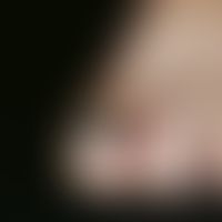 melanoma, malignant, acrolentiginous. solitary, chronically inpatient, since years existing, slig...