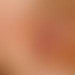 Melanom, malignes, akrolentiginöses.&nbsp; Auflichtmikroskopie.&nbsp;Streifige, braune (melanotis...