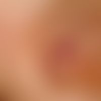 Melanom, malignes, akrolentiginöses.&nbsp; Auflichtmikroskopie.&nbsp;Streifige, braune (melanotis...