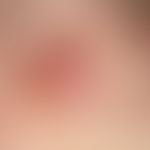 Melanom, malignes, amelanotisches. Detailvergrößerung: Kirschgroßer, oberflächlich vollständig er...