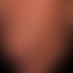 Melanom malignes, amelanotisches: seit Jahren bestehender rötlicher Knoten, der seit einigen Woch...