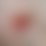Melanom, malignes, amelanotisches. Scharf begrfenzter, weitgehend amelanotischer flacher Knoten. ...