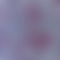 Melanom, malignes, desmoplastisches. Immunhistologie: S100-positive Zellhaufen in breit angelegte...