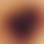 Melanoma, malignant, nodular. reflected light microscopy: Nodular malignant melanoma with "polypo...