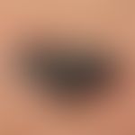 Melanoma, malignant, nodular. malignant melanoma of the primary-nodular type with satellite filia...