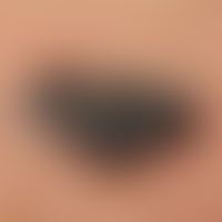 Melanom, malignes, noduläres. Malignes Melanom vom primär-nodulären Typ mit Satellitenfilia links...