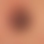 Melanoma, malignant, nodular. 26-year-old woman was diagnosed with an incidental finding on the b...
