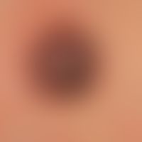 Melanom, malignes, noduläres. Als Zufallsbefund bei einer 26-jährigen Frau am Rücken diagnostizie...