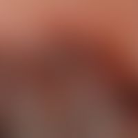 Melanom, malignes, noduläres. Detailvergrößerung eines nodulären malignen Melanoms mit atrophisch...