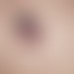 Melanoma, malignant, nodular. solitary, chronically active, growing rapidly in the last 4 weeks, ...