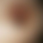 melanoma, malignant, nodular. solitary, since 1-2 years existing, ca. 0.8 cm in diameter, complet...