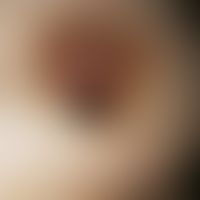 Melanom, malignes, noduläres. Solitärer, seit 1-2 Jahren bestehender, ca. 0,8 cm durchmessender, ...