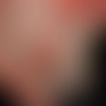 Melanoma malignant nodular: Cornu cutaneum-like malignant melanoma which was found only after sha...