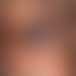 Melanoma, malignant, nodular, solitary, solid, sharply defined, surface smooth, non-hairy, black ...